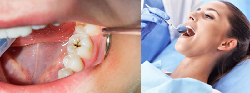 Cavity Treatment In South City 1