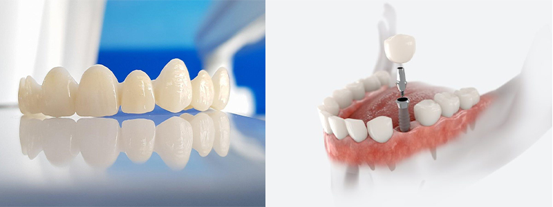 Dental Implants In Abul Fazal Enclave