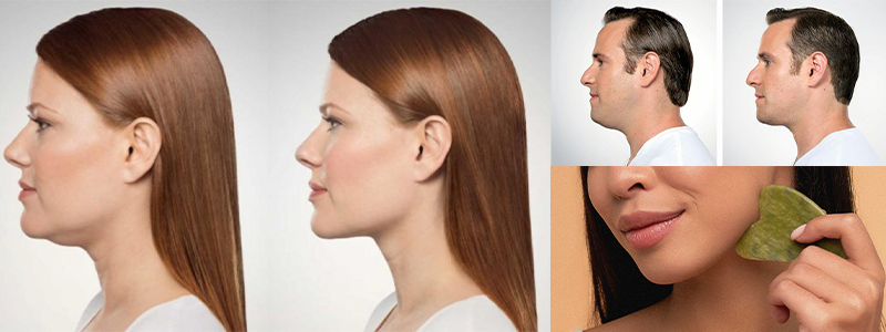 Double Chin Removal  In Aman Vihar
