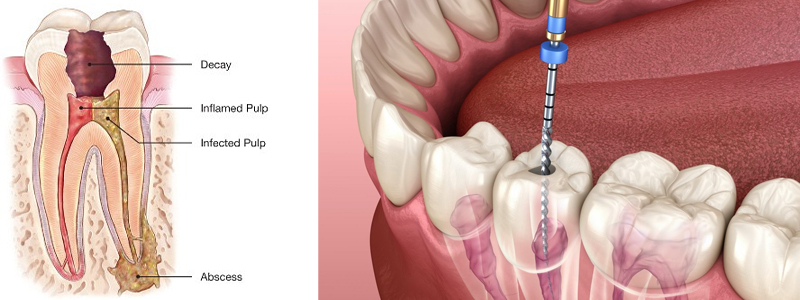 Root Canal Treatment In Amar Colony
