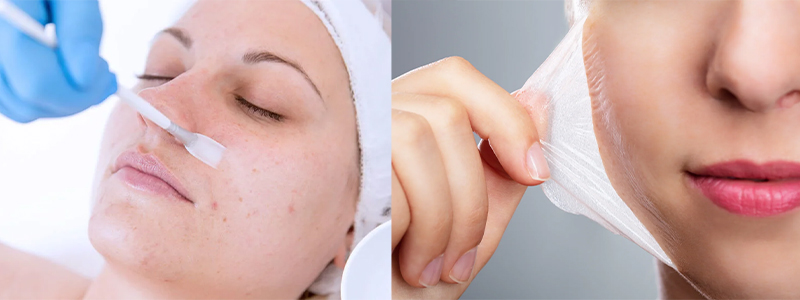 Skin Peeling Treatment In Amar Vihar