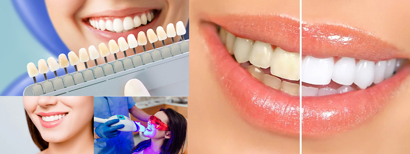 Teeth Whitening In Aman Vihar