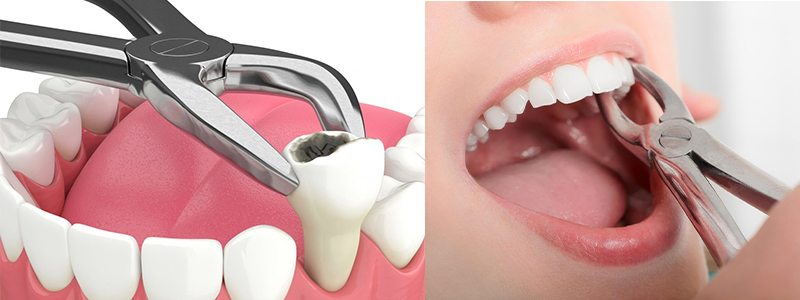 Tooth Extraction In Shree Nagar